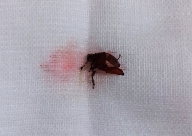 TP.HCM: Bé trai 9 tuổi đang ngủ bị vật thể lạ chui vào tai suýt thủng màng nhĩ