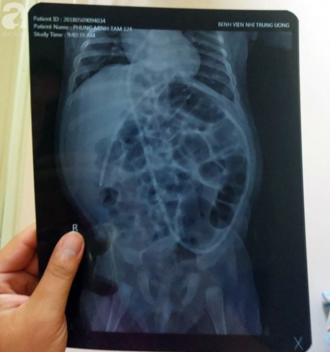 Tiếng khóc xé lòng của bé trai hơn 5 tháng tuổi mắc bệnh não úng thủy