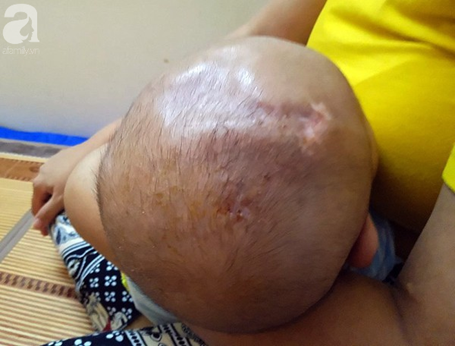 Tiếng khóc xé lòng của bé trai hơn 5 tháng tuổi mắc bệnh não úng thủy