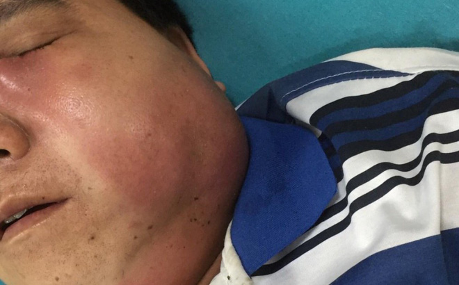 Tự mua thuốc chữa viêm họng, bệnh nhân nhiễm trùng máu, biến dạng khuôn mặt