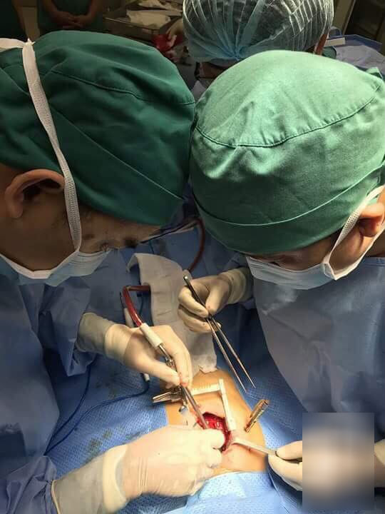 Cầm bút bi chạy chơi, bé gái 4 tuổi bị bút đâm xuyên thấu ngực