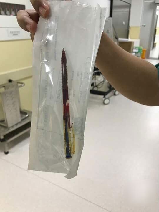 Cầm bút bi chạy chơi, bé gái 4 tuổi bị bút đâm xuyên thấu ngực