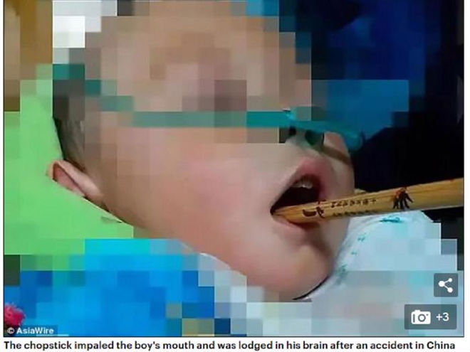 Cầm bút bi chạy chơi, bé gái 4 tuổi bị bút đâm xuyên thấu ngực