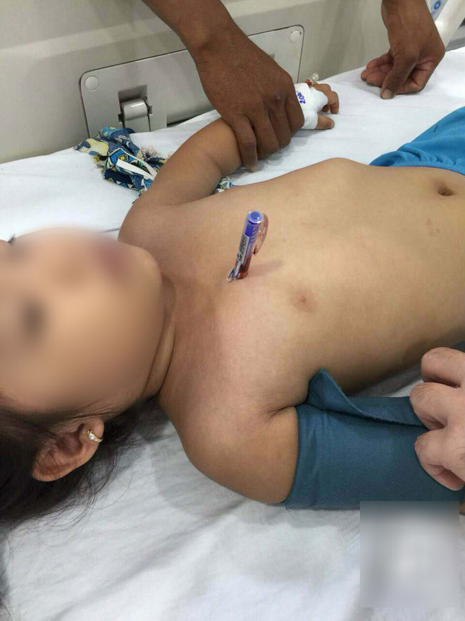 Cầm bút bi chạy chơi, bé gái 4 tuổi bị bút đâm xuyên thấu ngực