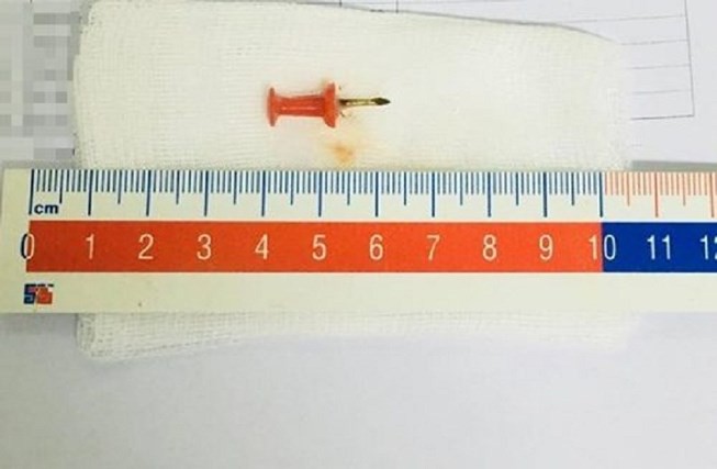 Nuốt phải đinh sắt 1,5cm vào bụng, bé 2 tuổi suýt chết Nuốt phải đinh sắt 1,5cm vào bụng, bé 2 tuổi suýt chết