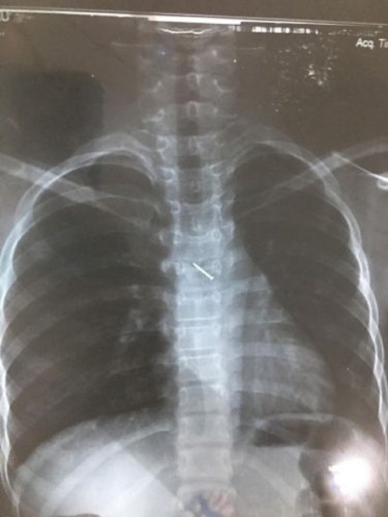 Nuốt phải đinh sắt 1,5cm vào bụng, bé 2 tuổi suýt chết