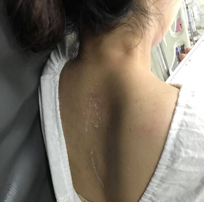 Hà Nội: Sự thật thông tin cô gái nghi bị mẹ chồng thuê người đổ keo 502 khắp đầu