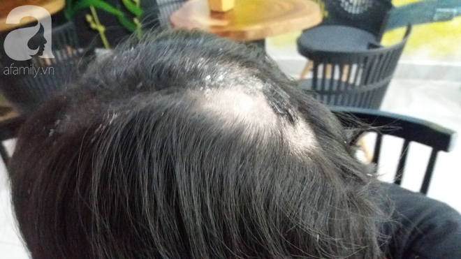 Hà Nội: Sự thật thông tin cô gái nghi bị mẹ chồng thuê người đổ keo 502 khắp đầu