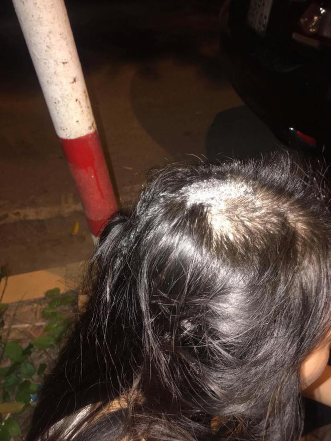 Hà Nội: Sự thật thông tin cô gái nghi bị mẹ chồng thuê người đổ keo 502 khắp đầu