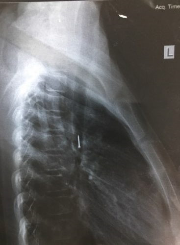 Phát hiện đinh ghim sắt trong phế quản bé gái 12 tuổi