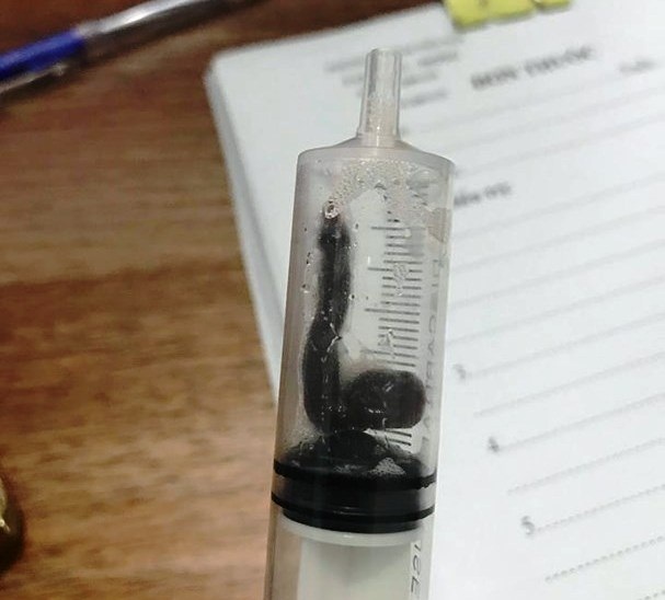 Vắt sống và hút máu trong mũi 2 bệnh nhân gần tháng trời