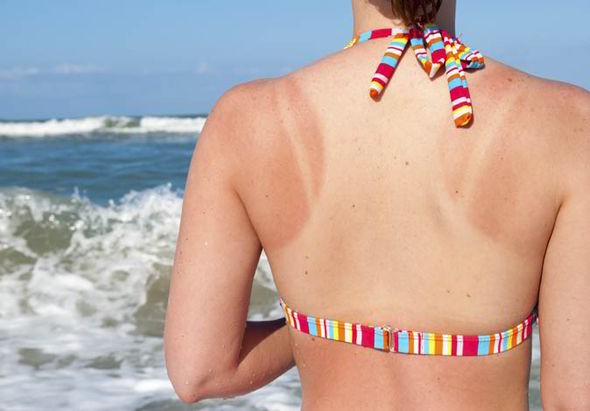 Cách phân biệt say nắng, cháy nắng, mất nước trong mùa hè