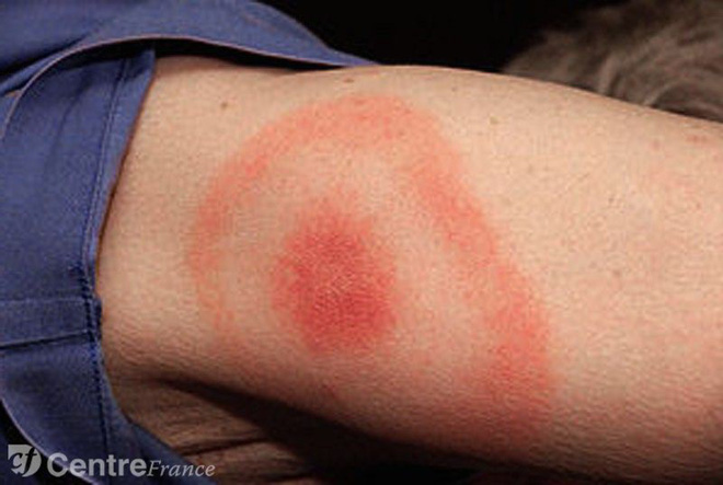 Căn bệnh thường xuất hiện vào mùa hè dễ gây biến chứng viêm màng não nếu không được chẩn đoán và điều trị đúng