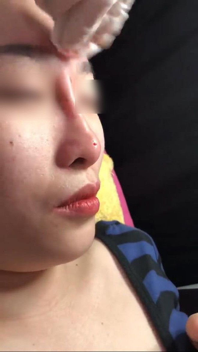 Clip tiêm Filler vào mũi sau đó bóp nặn thành dáng cao dài thẳng tắp đang được nhiều chị em chia sẻ vì... quá đáng sợ