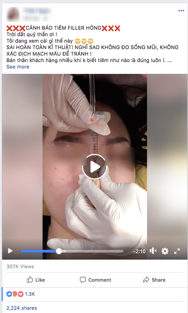 Clip tiêm Filler vào mũi sau đó bóp nặn thành dáng cao dài thẳng tắp đang được nhiều chị em chia sẻ vì... quá đáng sợ