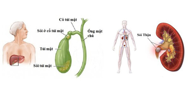 3 thói quen trong bữa tối đang nuôi lớn nhiều căn bệnh nguy hiểm: Hãy sớm tránh xa! 3 thói quen trong bữa tối đang nuôi lớn nhiều căn bệnh nguy hiểm: Hãy sớm tránh xa!