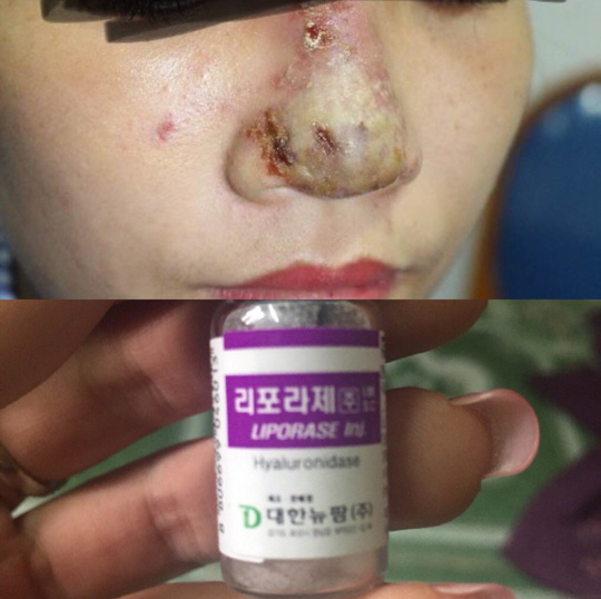 Cô gái 23 tuổi bị hoại tử mũi sau tiêm filler tại một spa