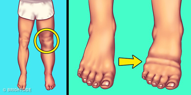5 dấu hiệu cảnh báo cơ thể bạn đang dư thừa quá nhiều muối 5 dấu hiệu cảnh báo cơ thể bạn đang dư thừa quá nhiều muối