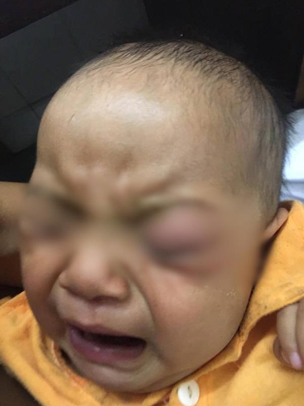 Mẹ vắt sữa chữa đỏ mắt cho con, bé trai 7 tháng tuổi phải bỏ một mắt vì hoại tử