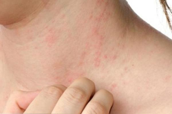 Không quan hệ cũng mắc bệnh giang mai, chàng trai nhớ lại chuyện 2 tháng trước mới hối hận Không quan hệ cũng mắc bệnh giang mai, chàng trai nhớ lại chuyện 2 tháng trước mới hối hận