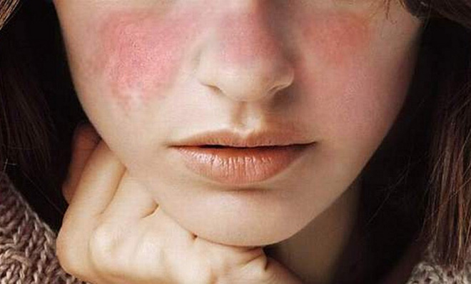 Rụng tóc quá nhiều: có thể bạn đã mắc phải 1 trong 5 chứng bệnh sau Rụng tóc quá nhiều: có thể bạn đã mắc phải 1 trong 5 chứng bệnh sau