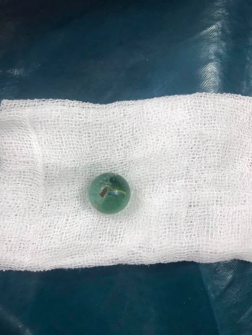 Cứu sống bé gái 6 tuổi nuốt viên bi vào khí quản