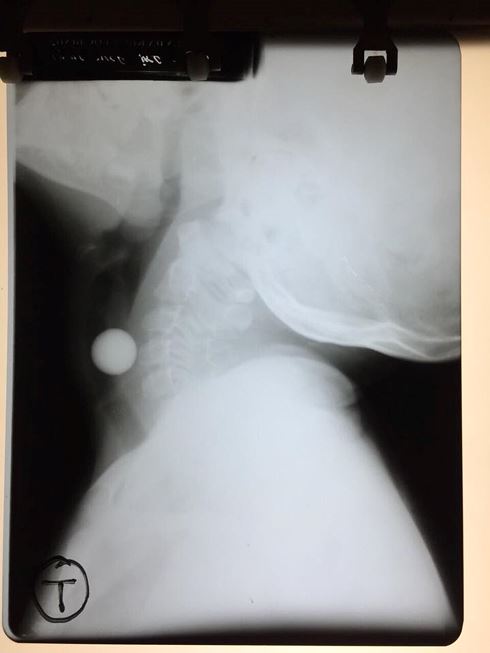 Cứu sống bé gái 6 tuổi nuốt viên bi vào khí quản