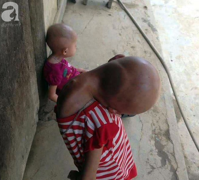 Tuyên Quang: 2 chị em gái mắc bệnh lạ khiến đầu, cổ bị nghẹo tựa người ngoài hành tinh khiến ai nhìn cũng xót xa