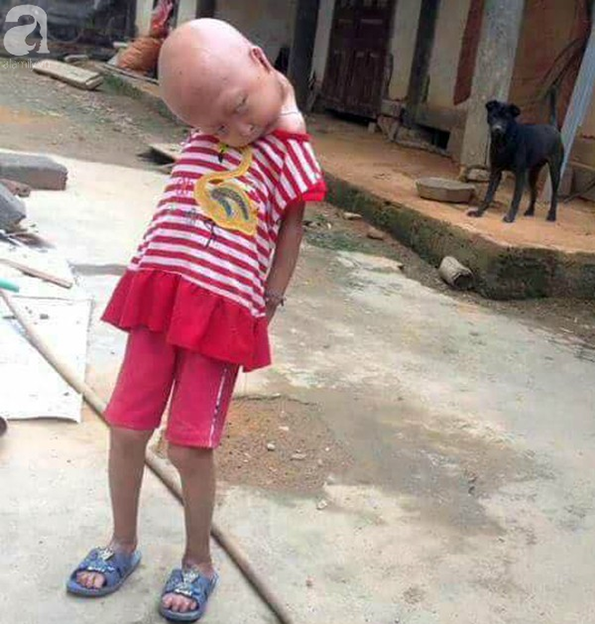 Tuyên Quang: 2 chị em gái mắc bệnh lạ khiến đầu, cổ bị nghẹo tựa người ngoài hành tinh khiến ai nhìn cũng xót xa