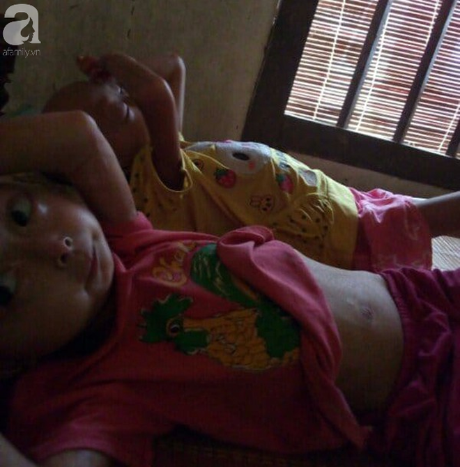 Tuyên Quang: 2 chị em gái mắc bệnh lạ khiến đầu, cổ bị nghẹo tựa người ngoài hành tinh khiến ai nhìn cũng xót xa