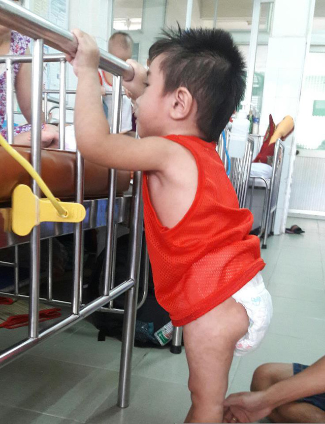 5 giờ phẫu thuật cứu bé trai 3 tuổi thoát cảnh mang bàng quang lộ ra ngoài bộ phận sinh dục