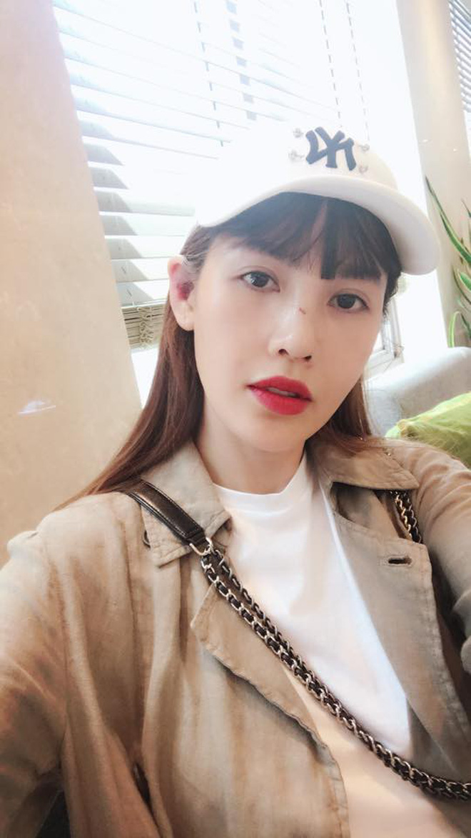 Cận cảnh gương mặt của Quế Vân sau cuộc phẫu thuật mũi lần thứ 6 Cận cảnh gương mặt của Quế Vân sau cuộc phẫu thuật mũi lần thứ 6