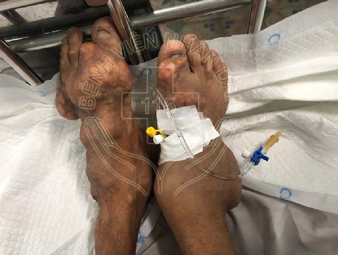 Long An: Người đàn ông bị biến dạng cơ thể nặng vì uống thuốc giảm đau trôi nổi suốt 10 năm trời