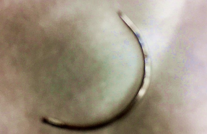 Bình Phước: Bác sĩ làm rơi kim khâu vào vùng kín khiến sản phụ chảy máu ồ ạt nguy hiểm?