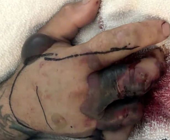 Rắn độc bị chặt đứt đầu vẫn cắn người suýt chết