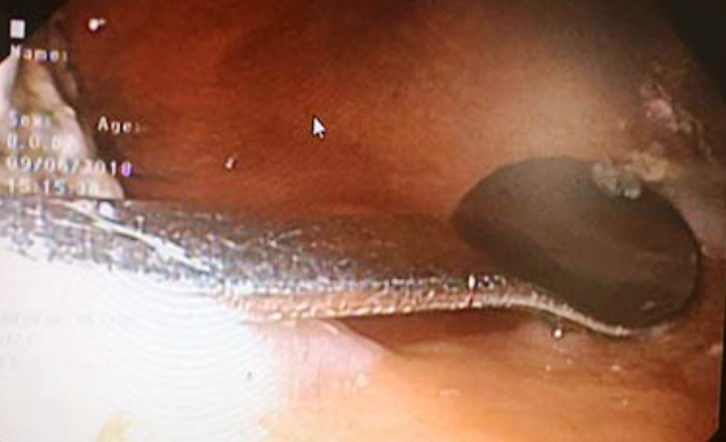 Cứu cô gái 20 tuổi đi uống cà phê nuốt chiếc thìa vào bụng