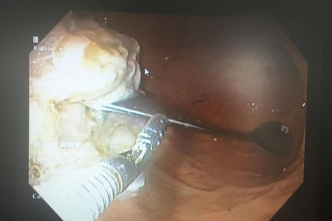 Hy hữu: Uống cà phê, cô gái nuốt luôn cả thìa vào bụng