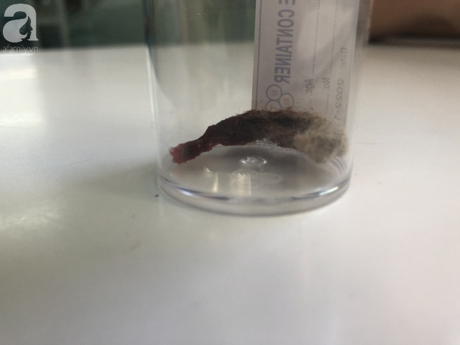 Bé gái 6 tuổi ở Bạc Liêu bị miếng bông vướng trong vùng kín, gây viêm nhiễm kéo dài