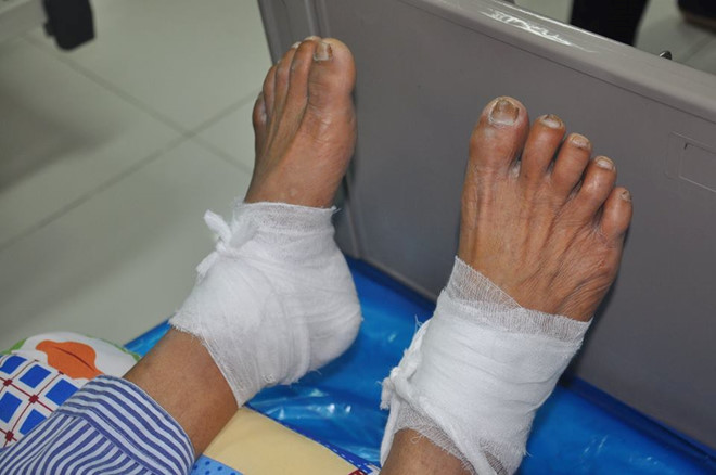 Người đàn ông bỏng độ 3 sau khi chườm nóng bằng lá ngải cứu