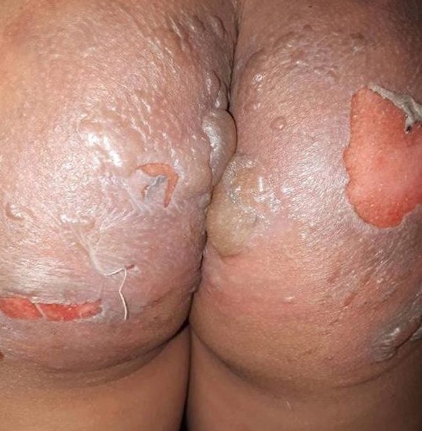 Hà Nội: Ngồi trên bậc thềm xem đá bóng, 2 cháu bé bị hàng xóm hất nồi nước luộc bầu vào người gây bỏng