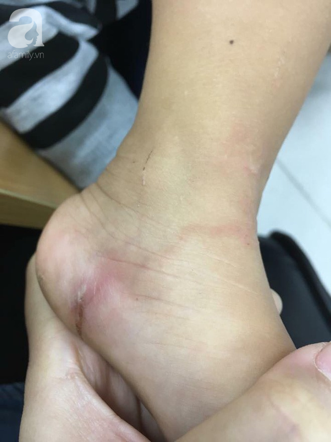 Về quê chơi dịp hè, bố kinh hãi phát hiện con gái 5 tuổi bị giun xâm nhập cơ thể, bò lúc nhúc dưới da