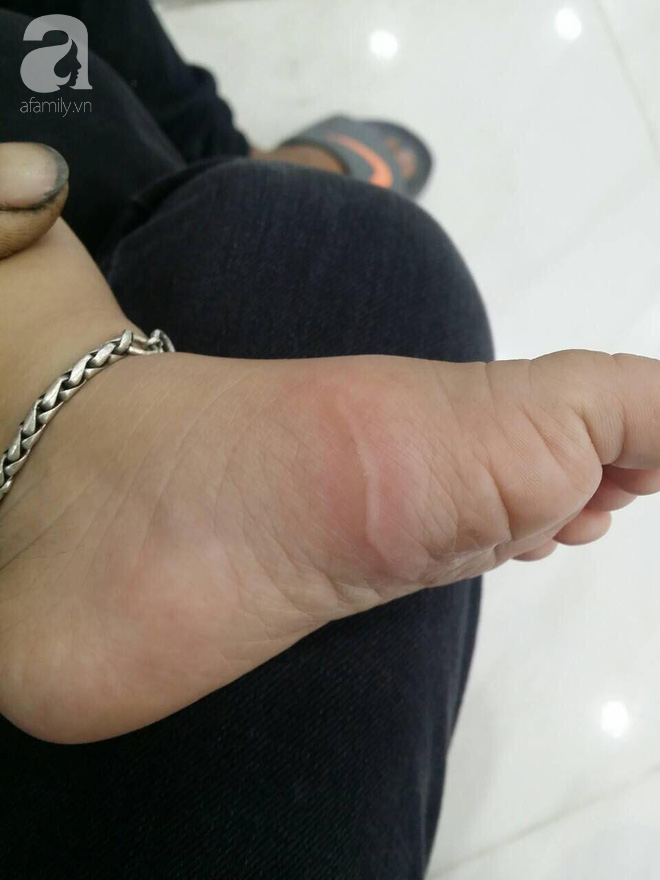 Về quê chơi dịp hè, bố kinh hãi phát hiện con gái 5 tuổi bị giun xâm nhập cơ thể, bò lúc nhúc dưới da