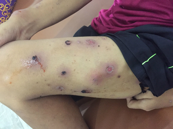 Bé trai bị nhiễm khuẩn huyết do biến chứng thủy đậu