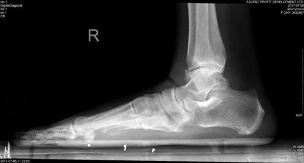 Thường đeo giày cao gót, người phụ nữ mắc bệnh bàn chân bẹt: kiểm tra ngay trước khi quá muộn!