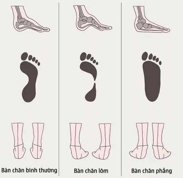 Thường đeo giày cao gót, người phụ nữ mắc bệnh bàn chân bẹt: kiểm tra ngay trước khi quá muộn! Thường đeo giày cao gót, người phụ nữ mắc bệnh bàn chân bẹt: kiểm tra ngay trước khi quá muộn!