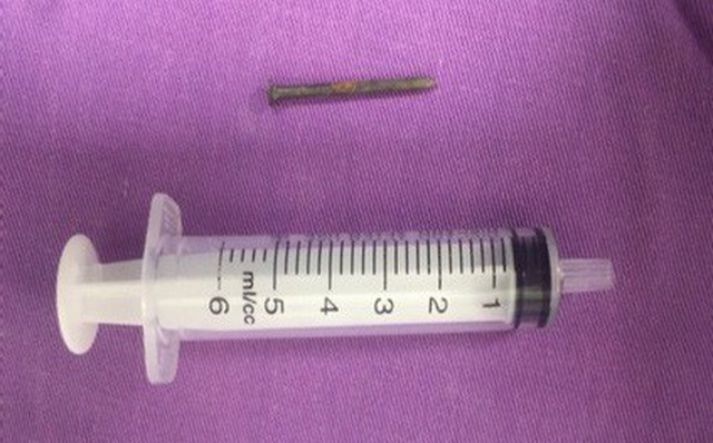 Quảng Ninh: Bé trai nuốt phải đinh sắt dài bằng nửa bơm tiêm, bác sĩ nín thở mổ bỏ dị vật