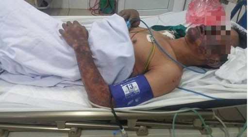 Thái Bình: 50 người bị ngộ độc sau khi ăn tiết canh lợn rừng