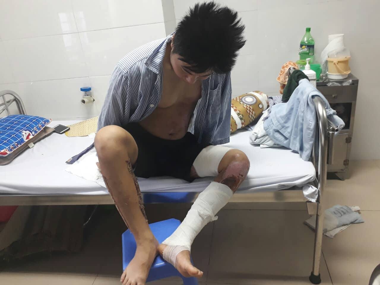 Hành trình phục hồi từ cơ thể bị bỏng nặng 40% đến body cơ bắp khỏe mạnh của chàng trai Thái Nguyên