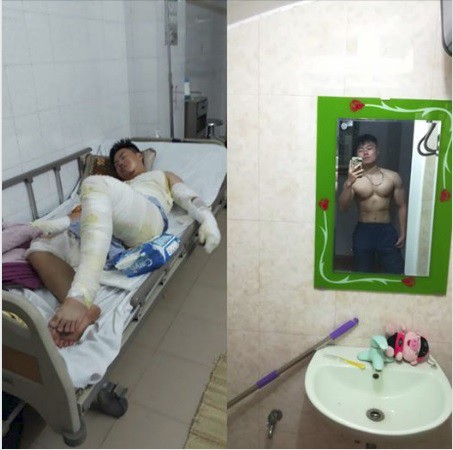 Hành trình phục hồi từ cơ thể bị bỏng nặng 40% đến body cơ bắp khỏe mạnh của chàng trai Thái Nguyên