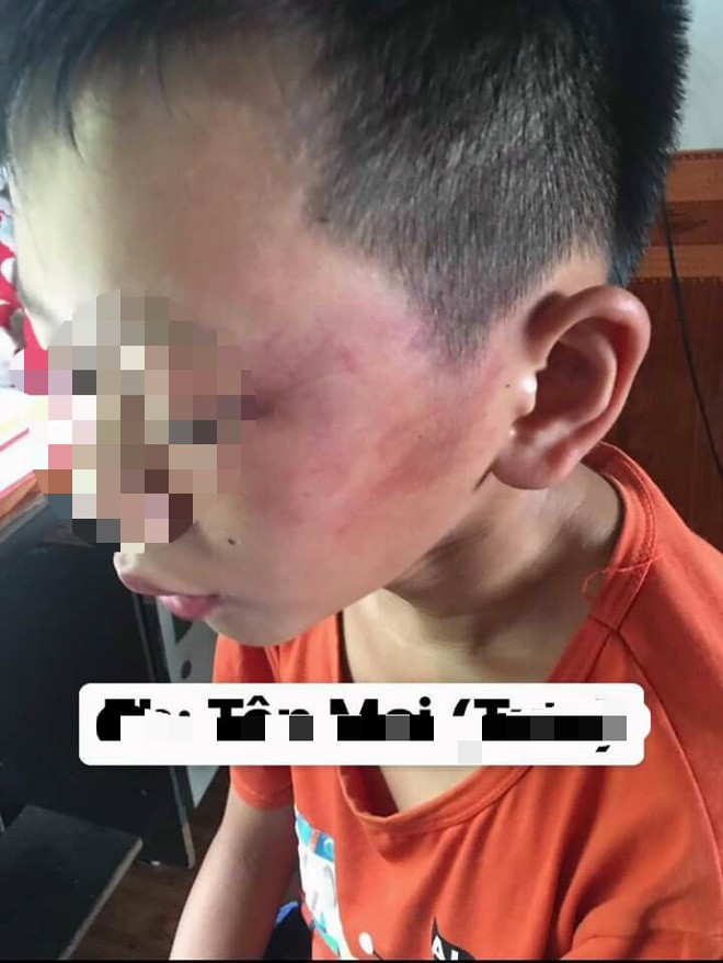 Nghệ An: Nghi án bé trai 12 tuổi bị mẹ kế đánh thương tích đầy mình phải nhập viện Nghệ An: Nghi án bé trai 12 tuổi bị mẹ kế đánh thương tích đầy mình phải nhập viện